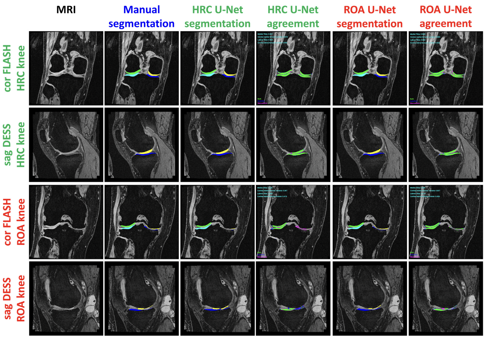 Agreement and accuracy of fully automated morphometric femorotibial cartilage analysis in radiographic knee osteoarthritis